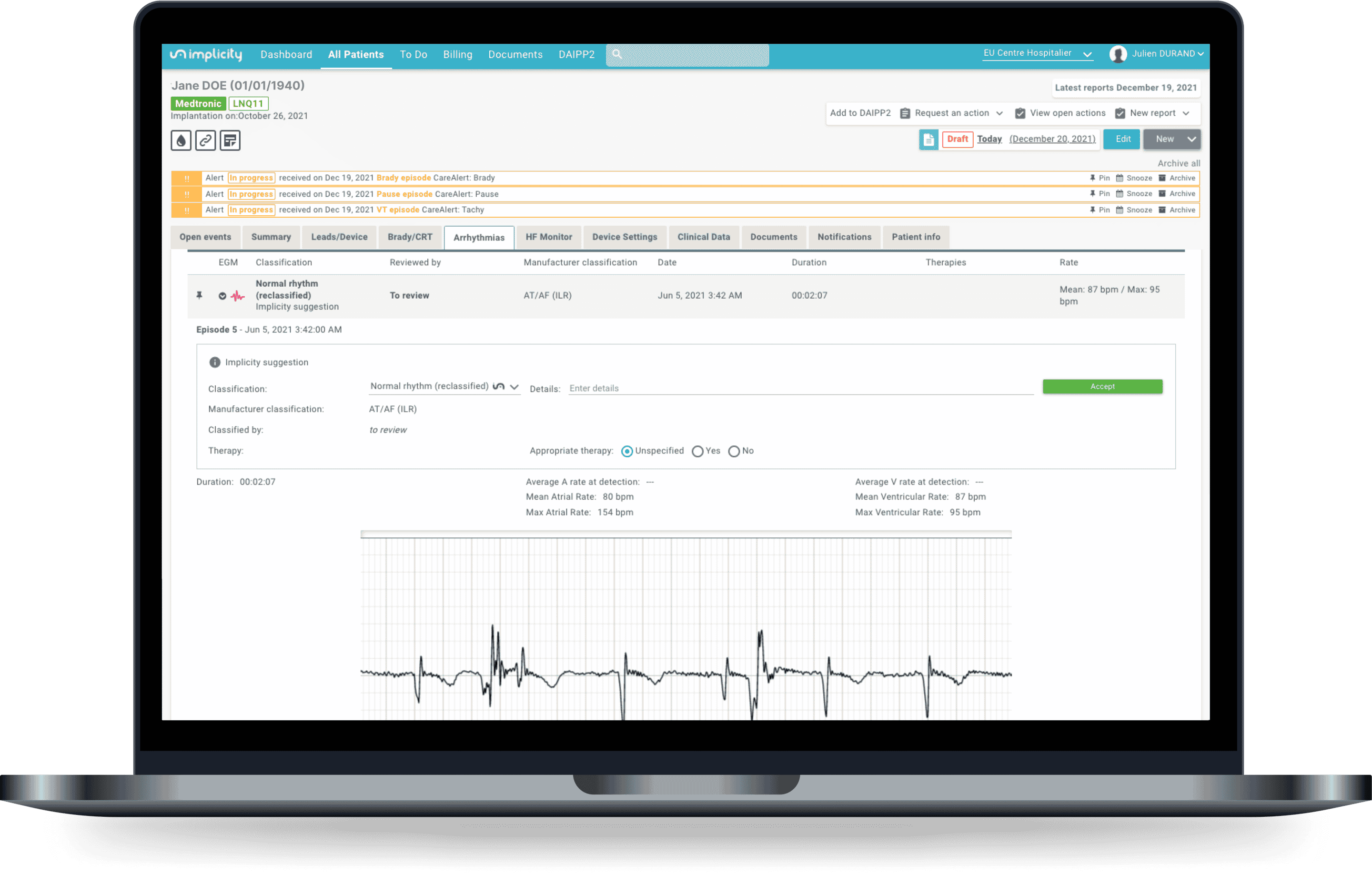 TestILR ECG Analyzer